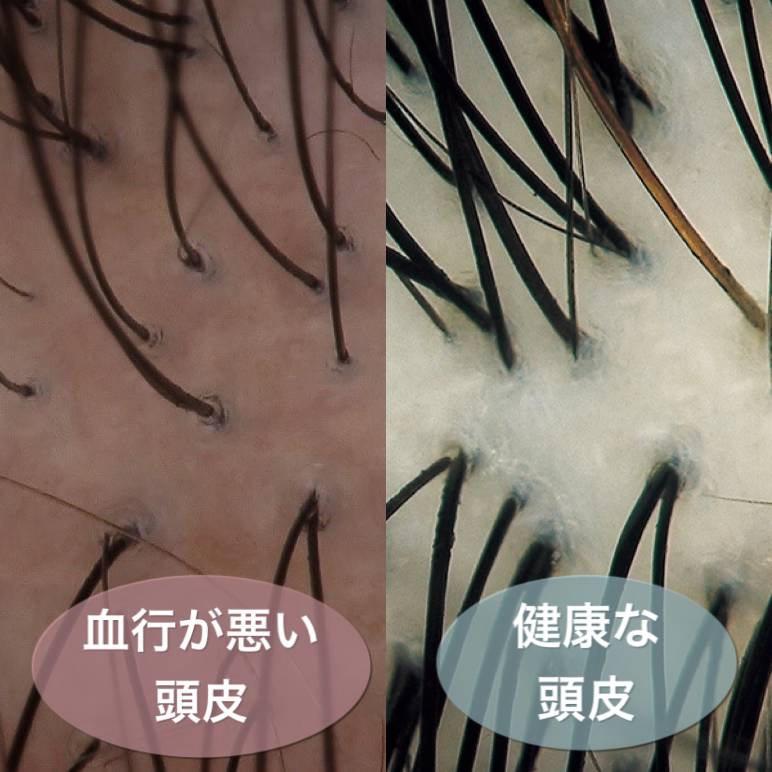 頭皮の血行不良は抜け毛 薄毛の原因 Room Hair ルームヘア 半個室のプライベート美容室 渋谷 杉並 世田谷 新宿